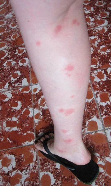 mosquito bites on calf, East Village Nomad