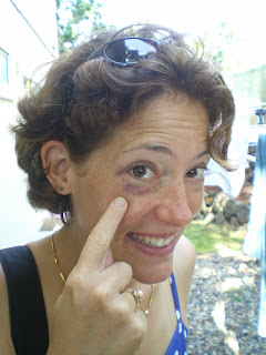 My black eye from boogie boarding